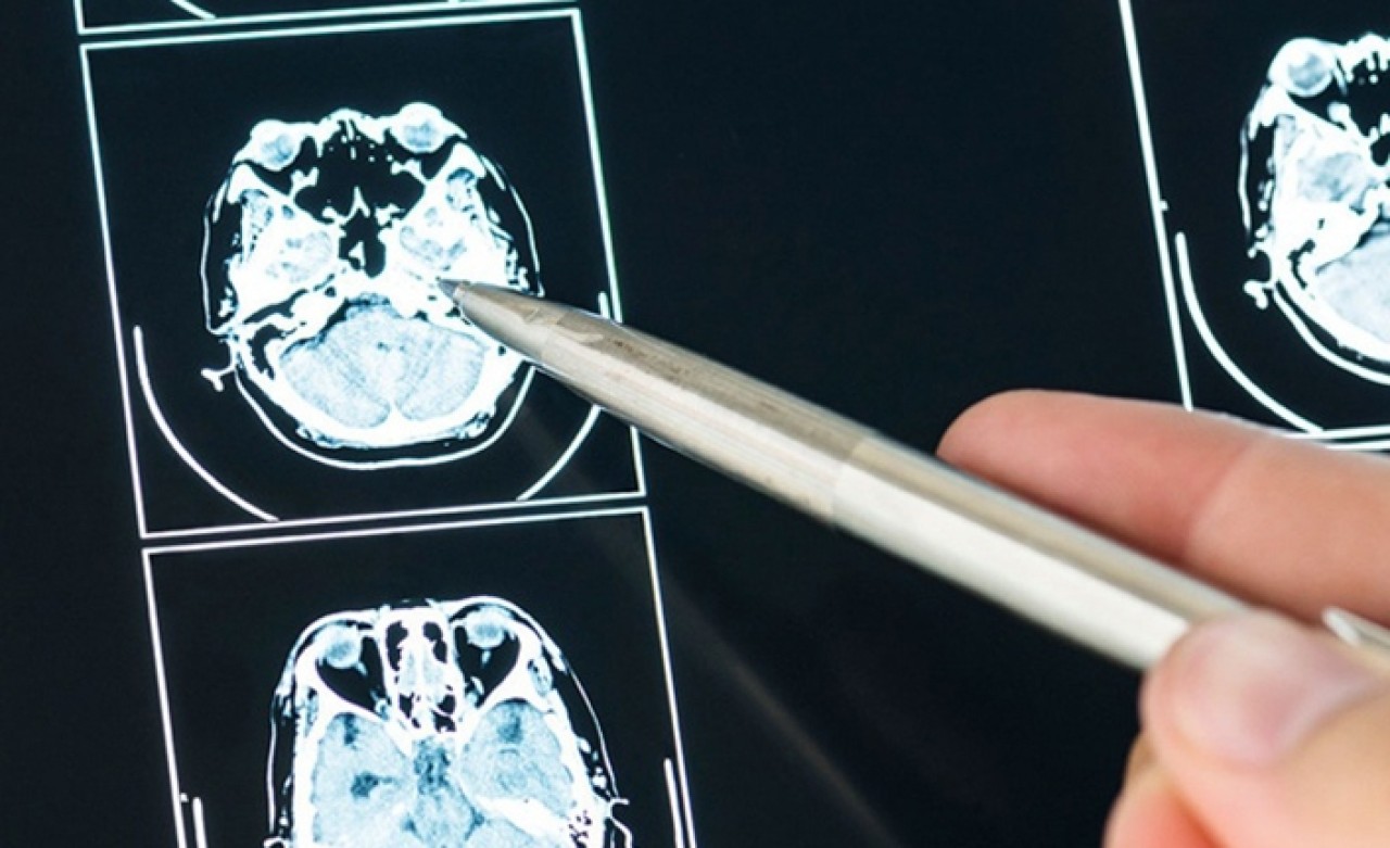 MS hastalığı,  kadınlarda 2 kat fazla görülüyor