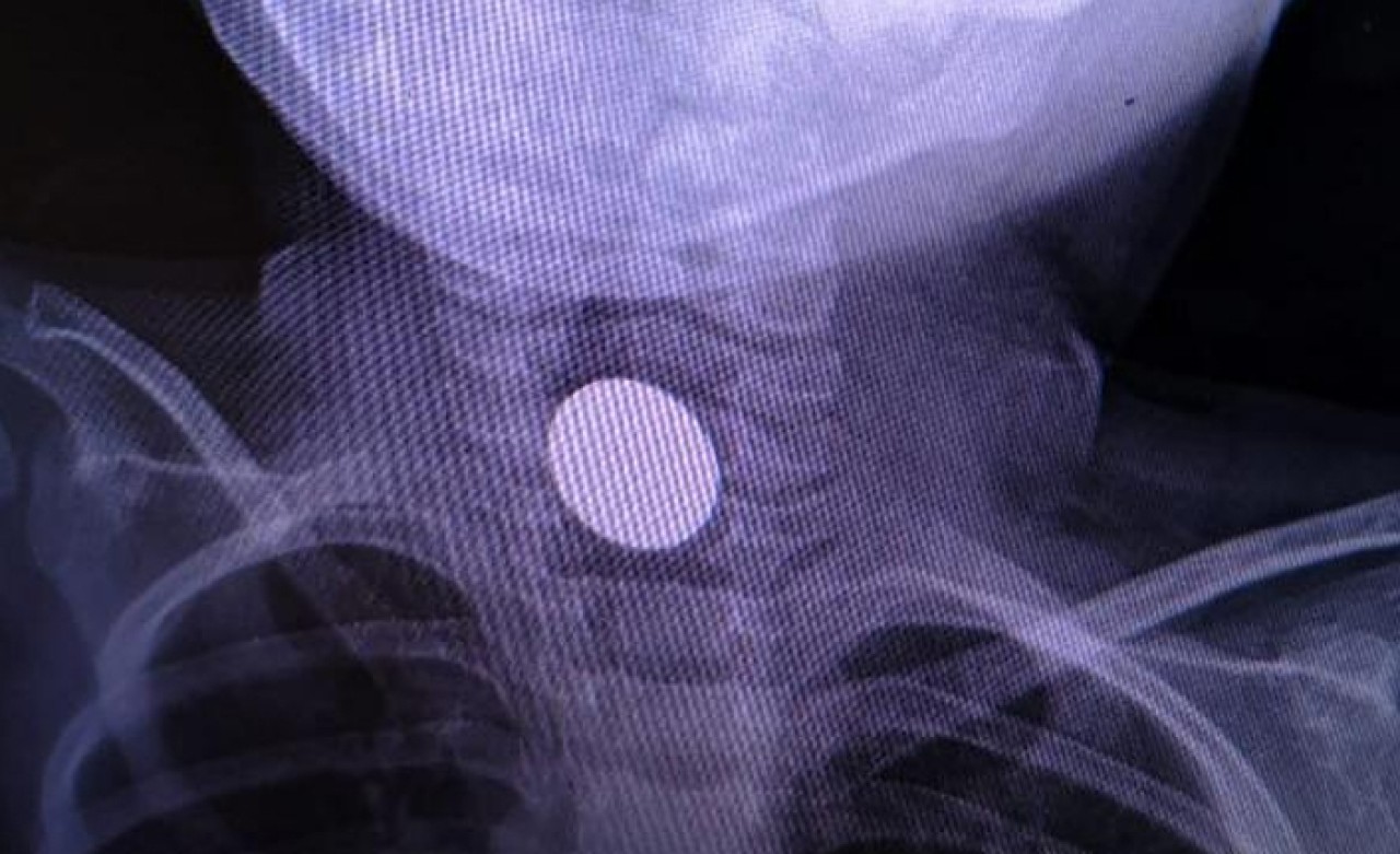 3 yaşındaki çocuğun boğazına madeni para takıldı