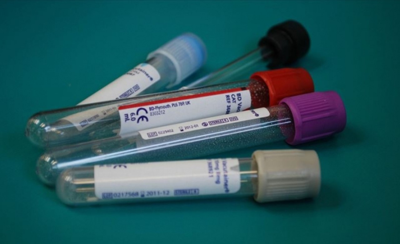 Hepatit virüsüne sahip her 10 kişiden 9'u hastalığından habersiz