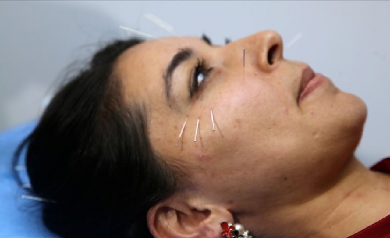 Kozmetik akupunktur ile en az 5 yaş daha genç görünmek mümkün