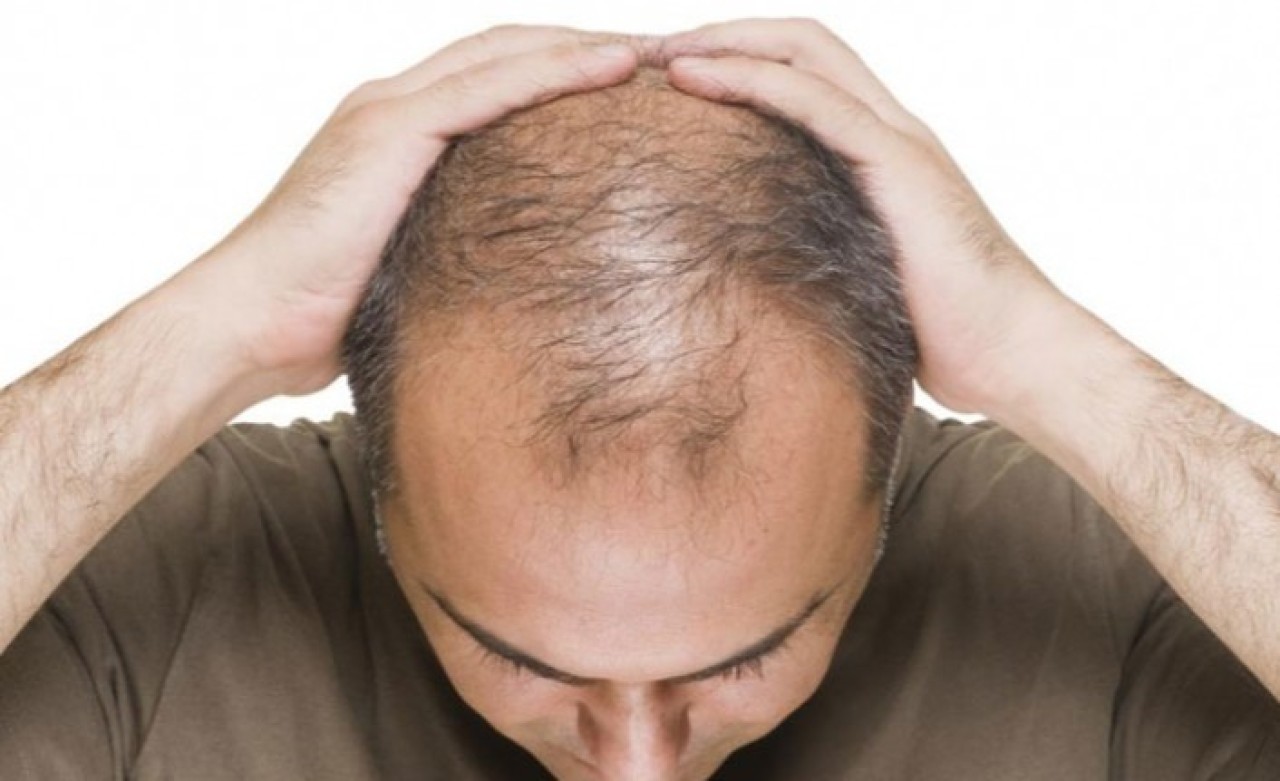 Kellik ile baş edebilmek için: Saç ekimi