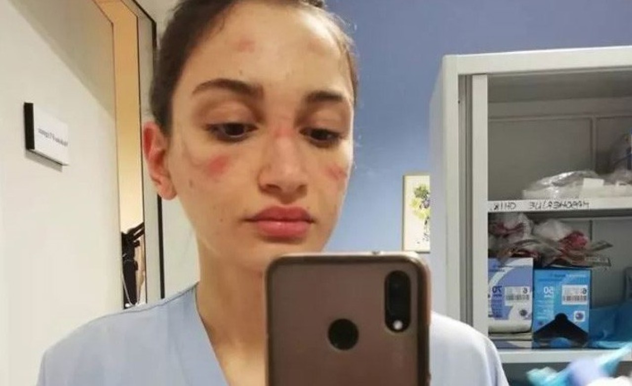 İtalyan hemşirenin yüzü bu hale geldi: "Korkuyorum"