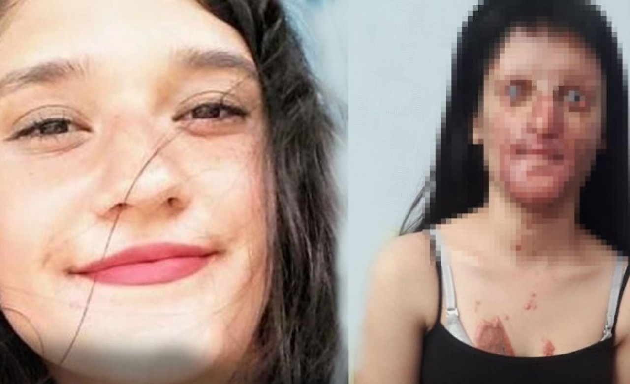 Erkek arkadaşının asitli saldırısına uğrayan Berfin Özek ilk kez konuştu!