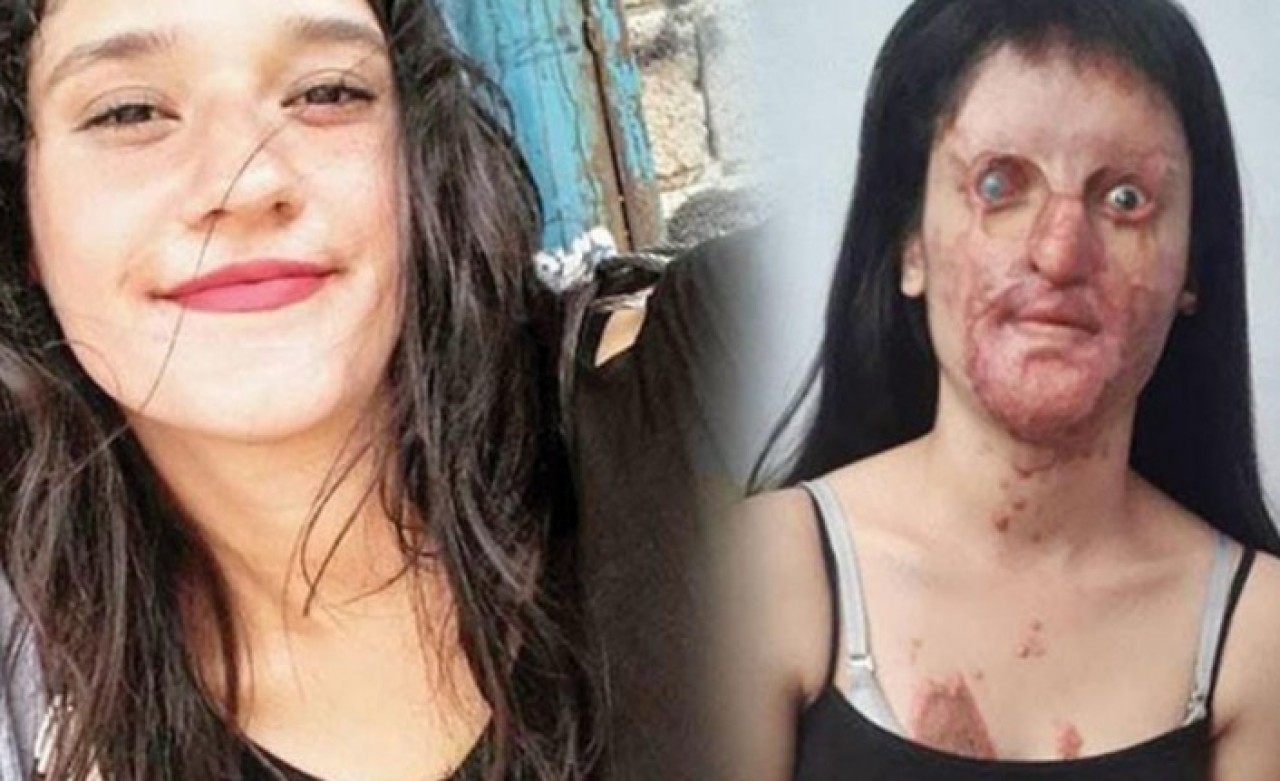 Yüzüne asit atılan Berfin Özek davasında flaş gelişme: Avukatı davadan çekildi!