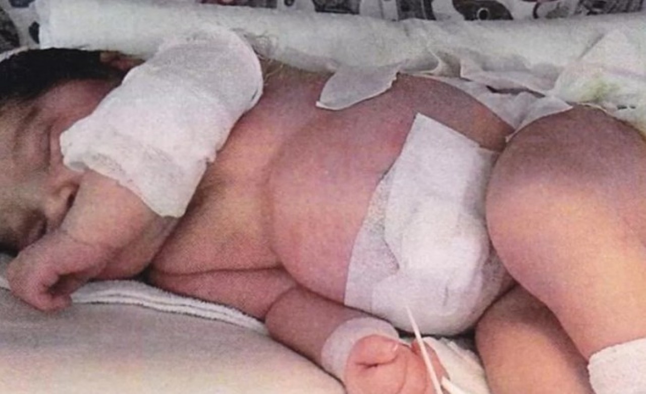 Doğumhanede ısıtıcıyla yandı,  18 gün komada kaldı!