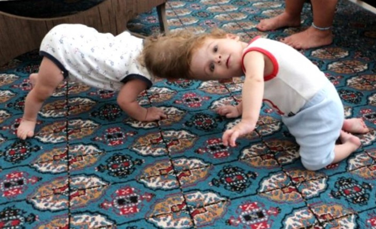 Özel operasyonla birbirlerinden ayrılan siyam ikizleri Derman ve Yiğit Evrensel'den ilk fotoğraf geldi!