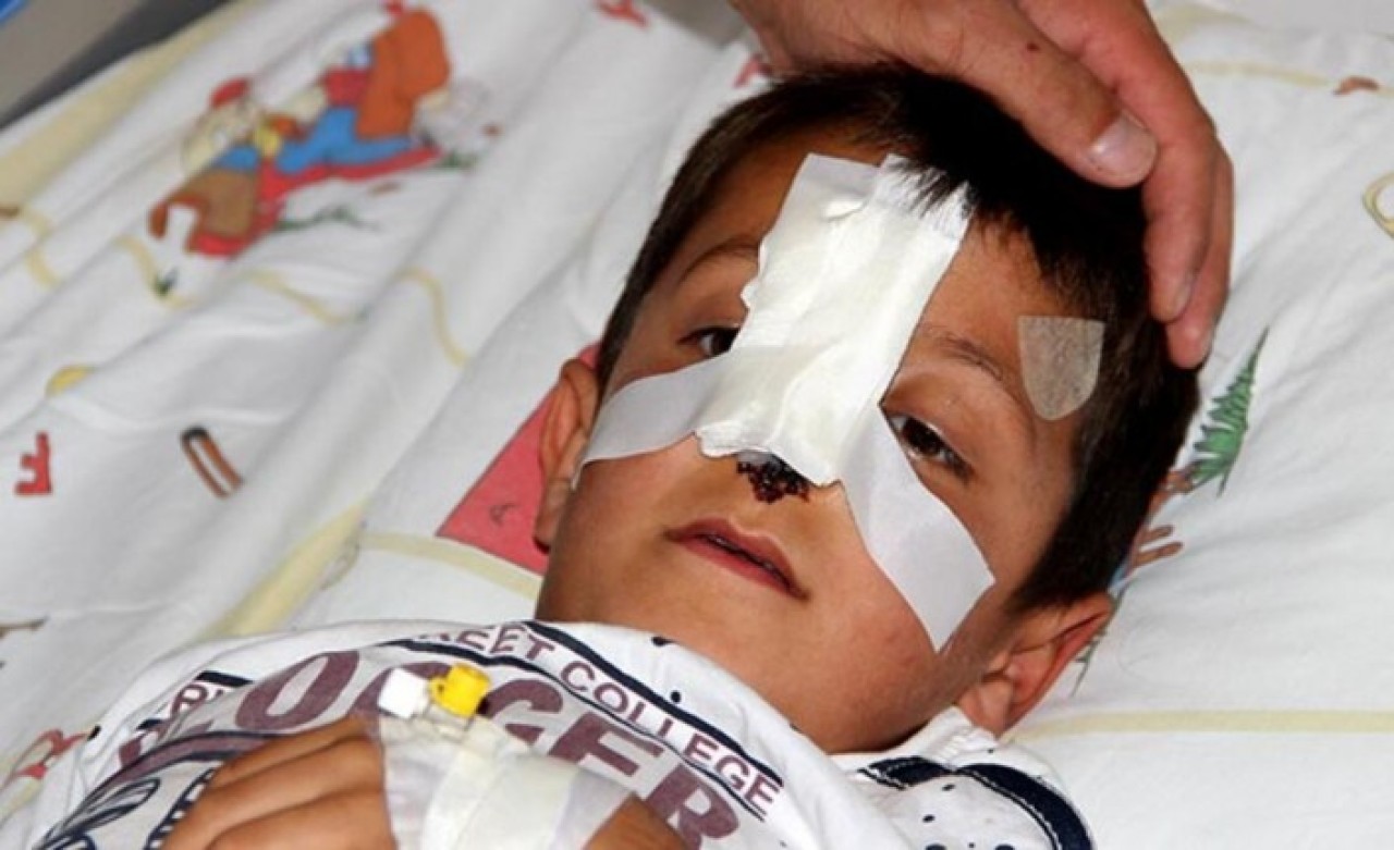 Başıboş dolaşan sokak köpeği küçük çocuğun burnunu kopardı!