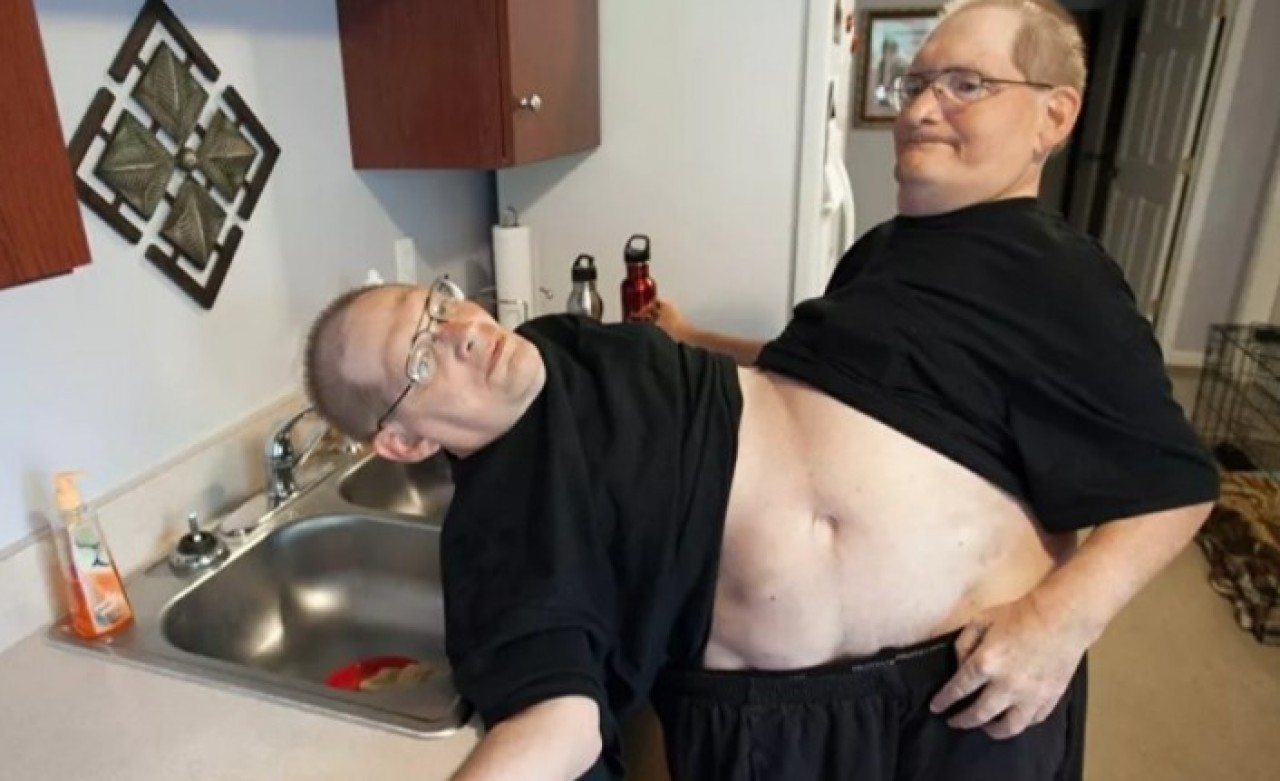 Dünyanın en uzun hayatta kalan yapışık ikizleri 68 yaşında öldü