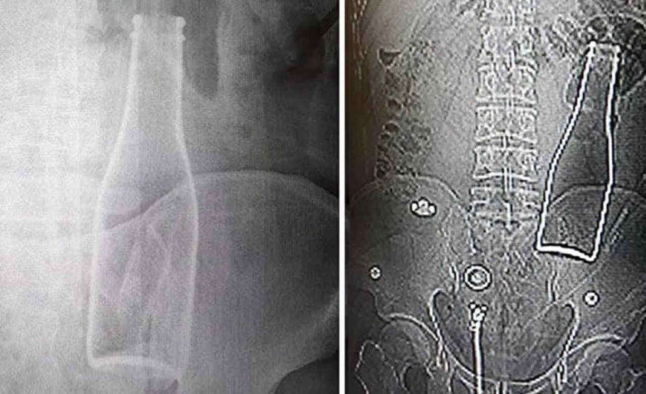 Kalın bağırsağından şişe çıkan genç: Yanlışlıkla oldu