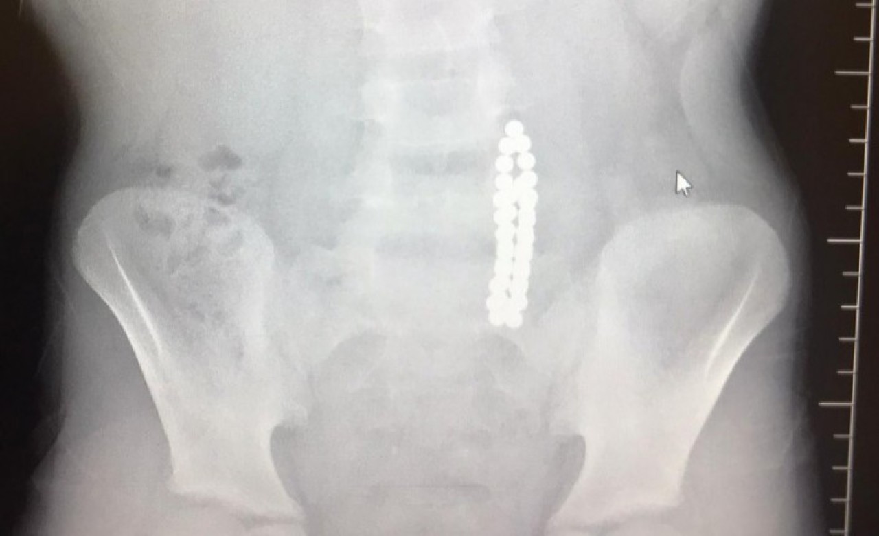 Karın ağrısıyla hastaneye giden çocuğun midesinden çıkanlar doktoru şoke etti!