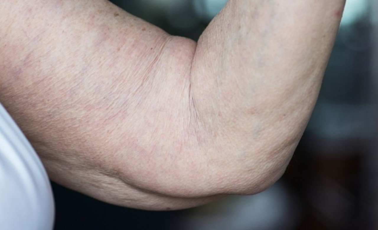 Lipödem’e dikkat: Kadınlarda sık görülüyor!