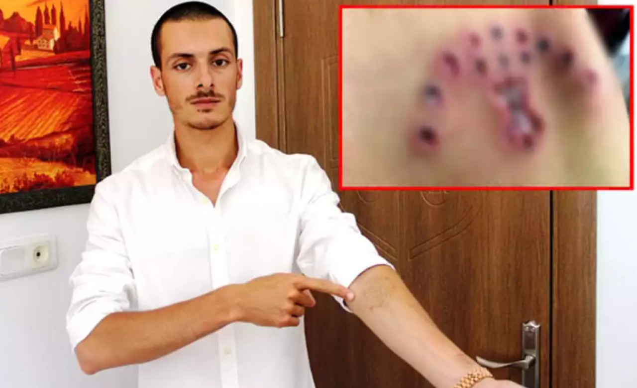 Özel harekatçı olmak için dövmelerini sildirmeye giden gencin hayatı karardı!