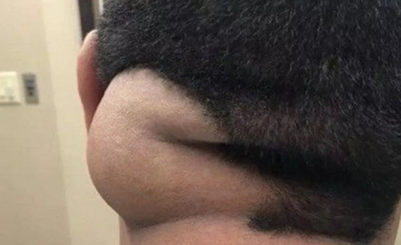 17 yıl boyunca kafasında hayvanla yaşadı