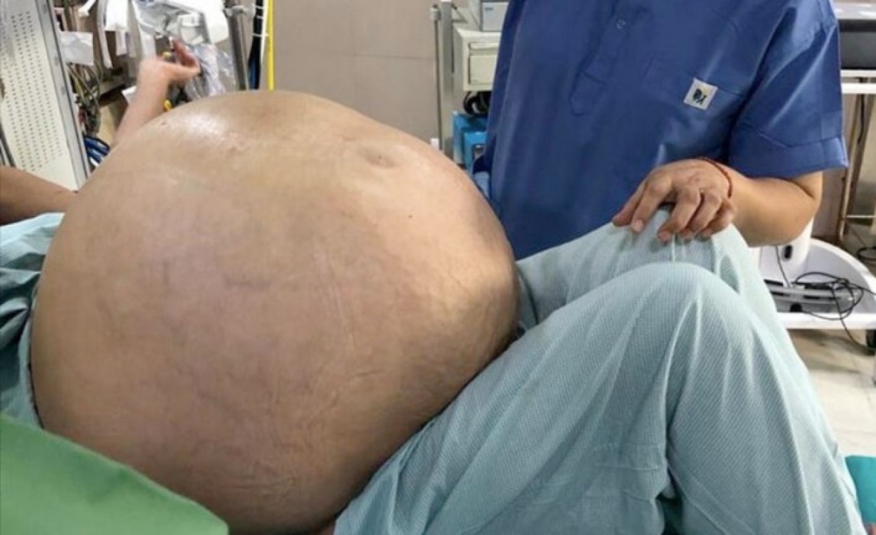 52 yaşındaki kadının karnından 54 kilo tümör çıkarıldı