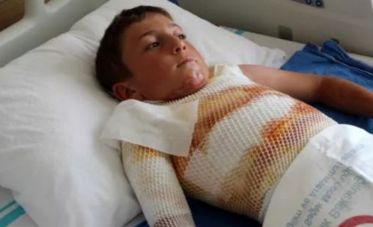 Ardahan'da 10 yaşındaki çocuk gömleğindeki ipi yakmak isterken kendini yaktı