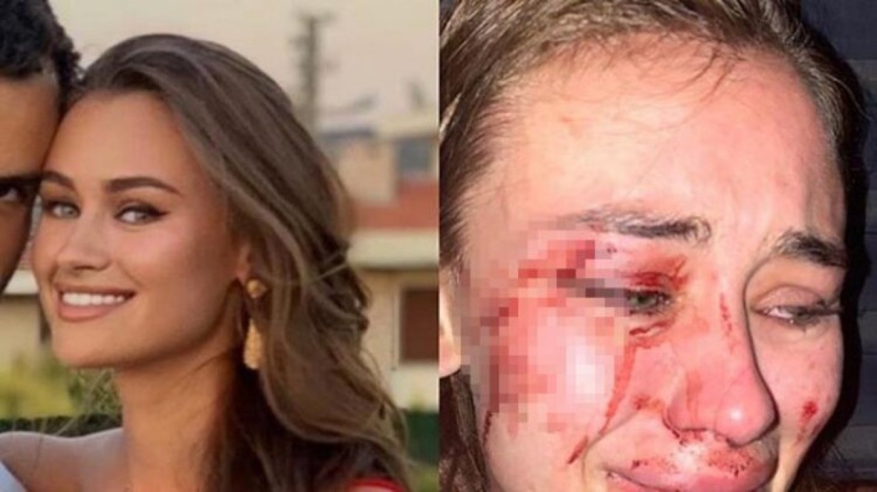 Dünyaca ünlü modele Çeşme'de feci dayak!