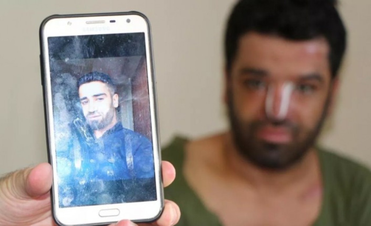 Epilepsi nöbeti sonrası sıcak suya düşen Bilal Cesur eski haline dönmek istiyor