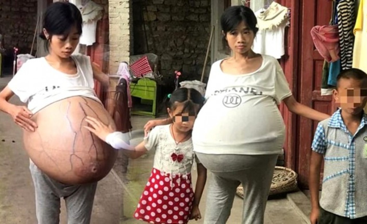 Karnında 20 kiloluk kütle taşıyan genç kadın tıp dünyasını şaşırttı