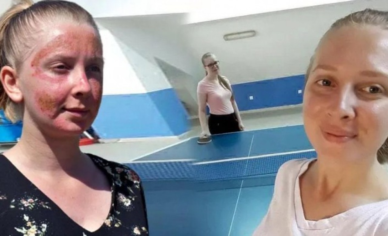 Cilt bakımı yaptıran Müge Gümşar'ın yüzü bu hale geldi: Aynaya bile bakamıyorum