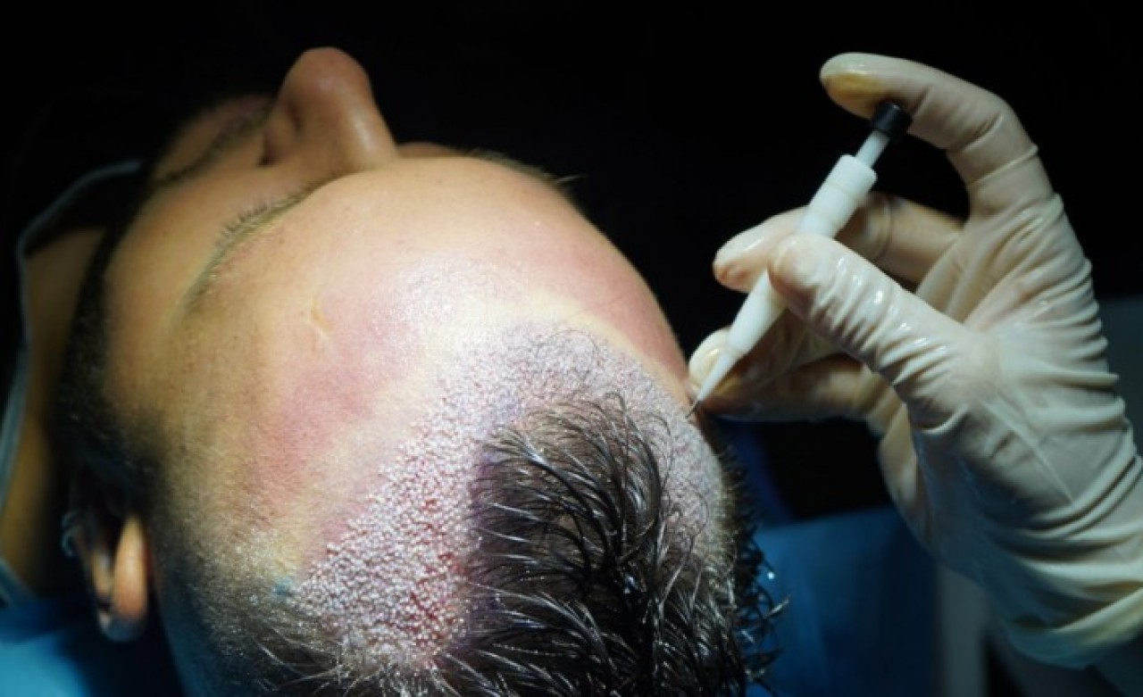 En İyi Saç Ekim Merkezleri Nelere Dikkat Ediyor?