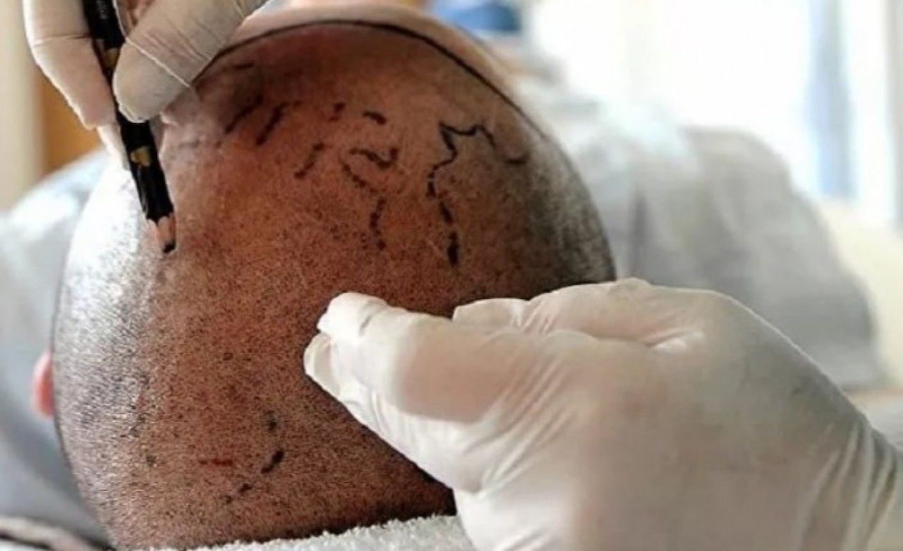 Saç ekiminin ardından rahatsızlanan hasta hayatını kaybetti