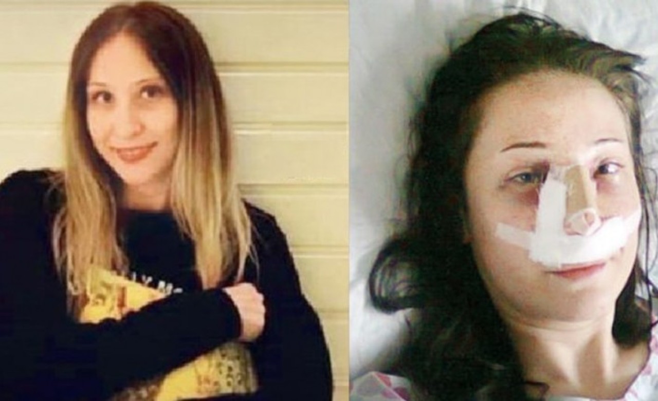 Burun estetiği ameliyatı olan Sevinç Çelik'in hayatı karardı!