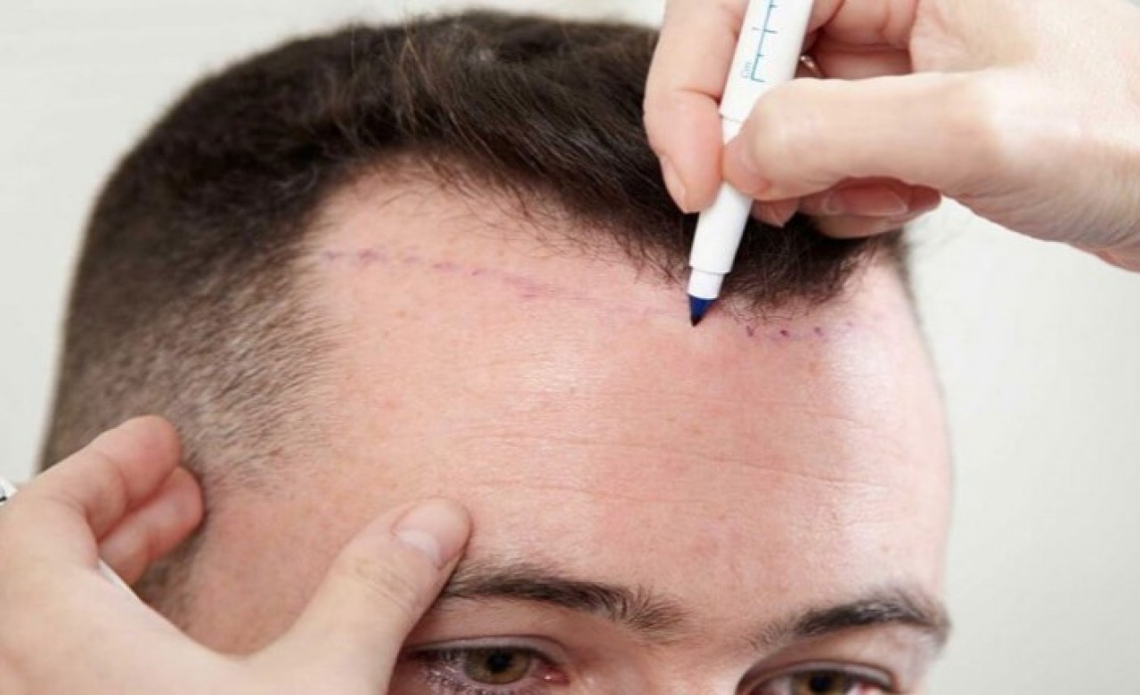 Saç Ekimi Merkezleri