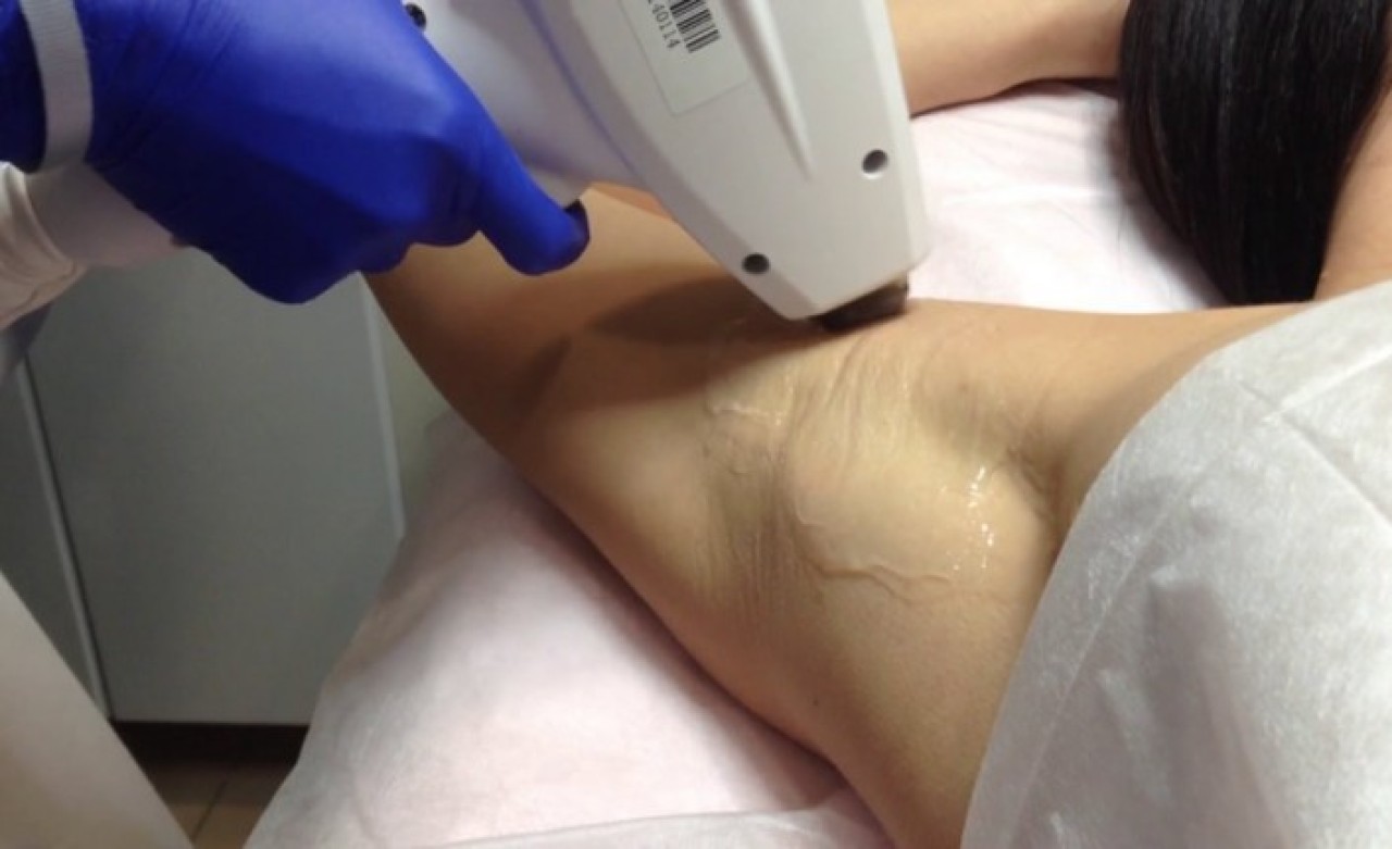 Buz Lazer Fiyatları