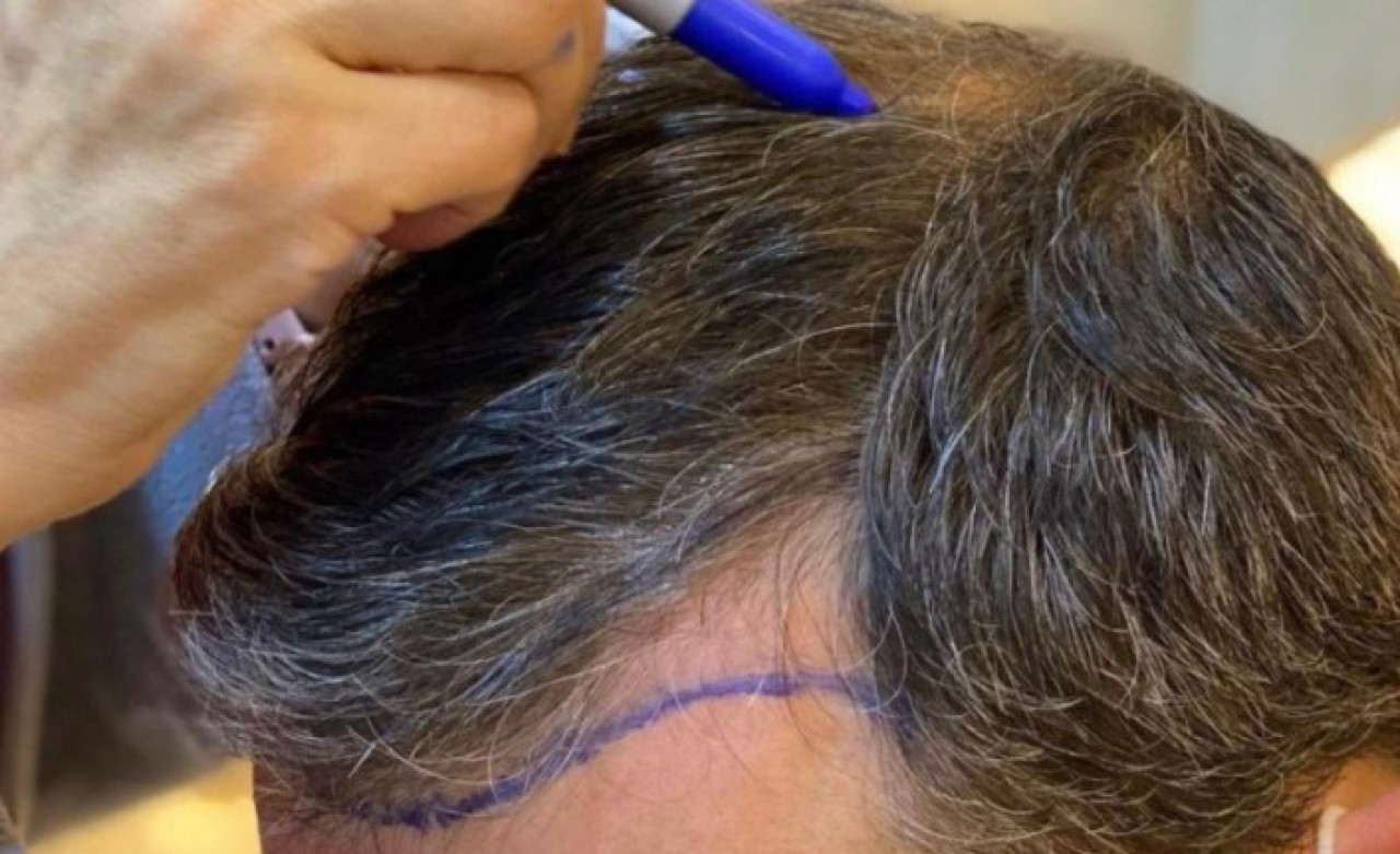 Saç Ekimi Aşamaları Nelerdir,  Neopital Anlatıyor!