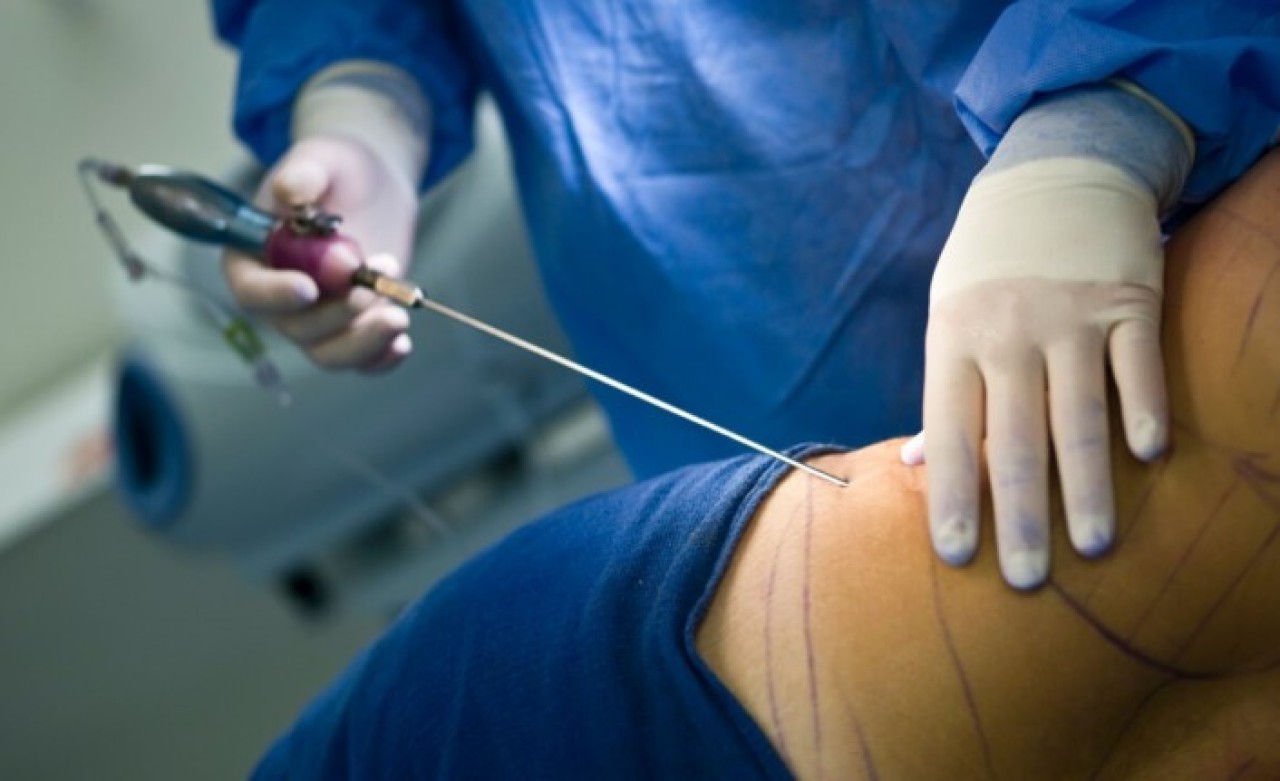 Op. Dr. Hüseyin Kandulu Liposuction Nedir?