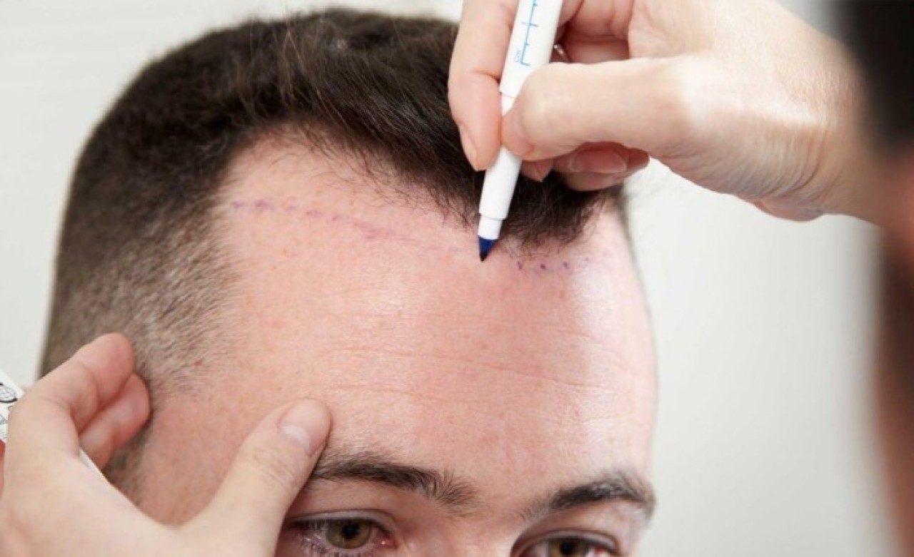 Retouch Body Clinic Saçlar Ektirme İle Doğal Görünüm