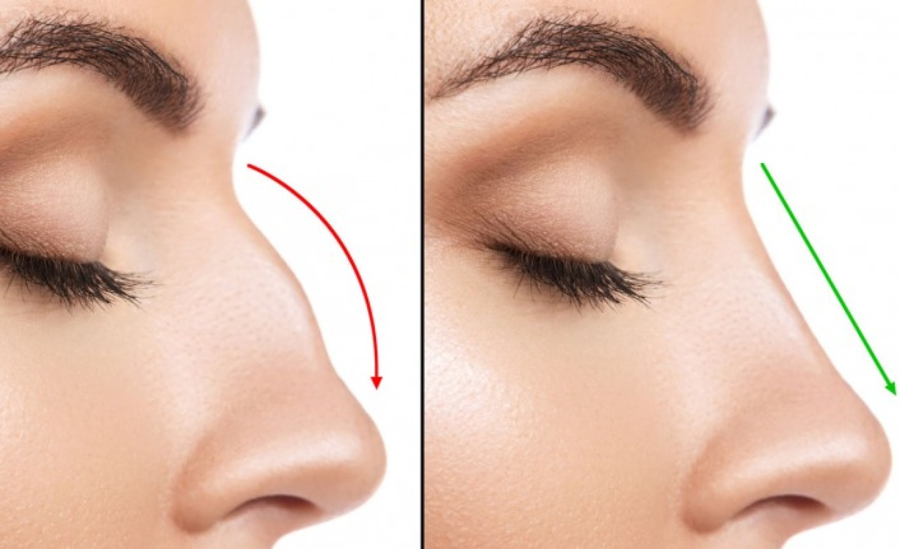 Op. Dr. Deniz Küçükkaya - Burun Estetik Yöntemleri