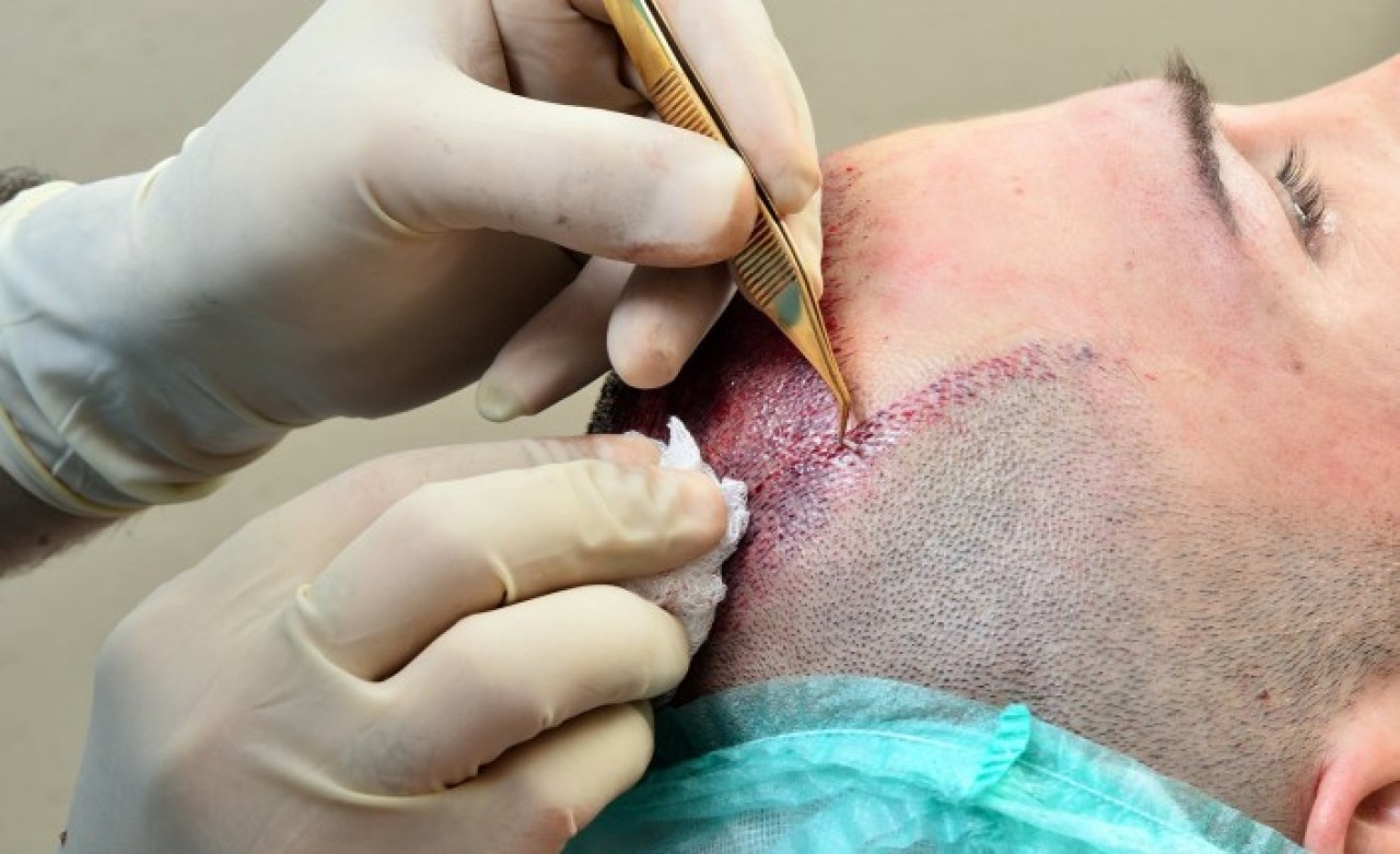 Saç Ekimi Nedir Ve Kimler Yaptırabilir? – Smile Hair Clinic