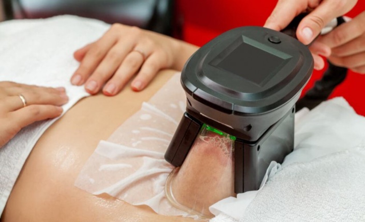 Soğuk Lipoliz Nedir?