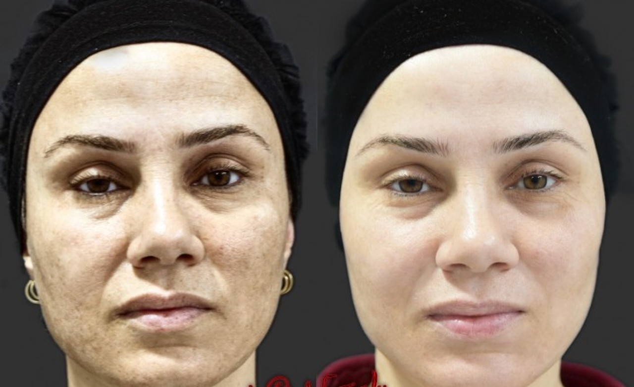 Dr. Nuket Eroğlu - Ameliyatsız yüz estetiği nedir? Orta yaşta sıklıkla hangi uygulamalara ihtiyaç duyulur?