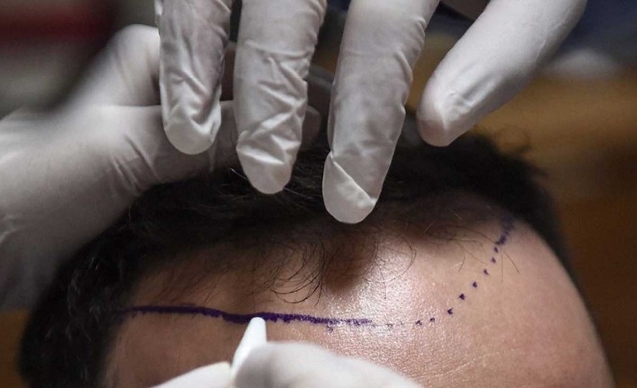 İstanbul’un En İyi Saç Ekim Merkezleri