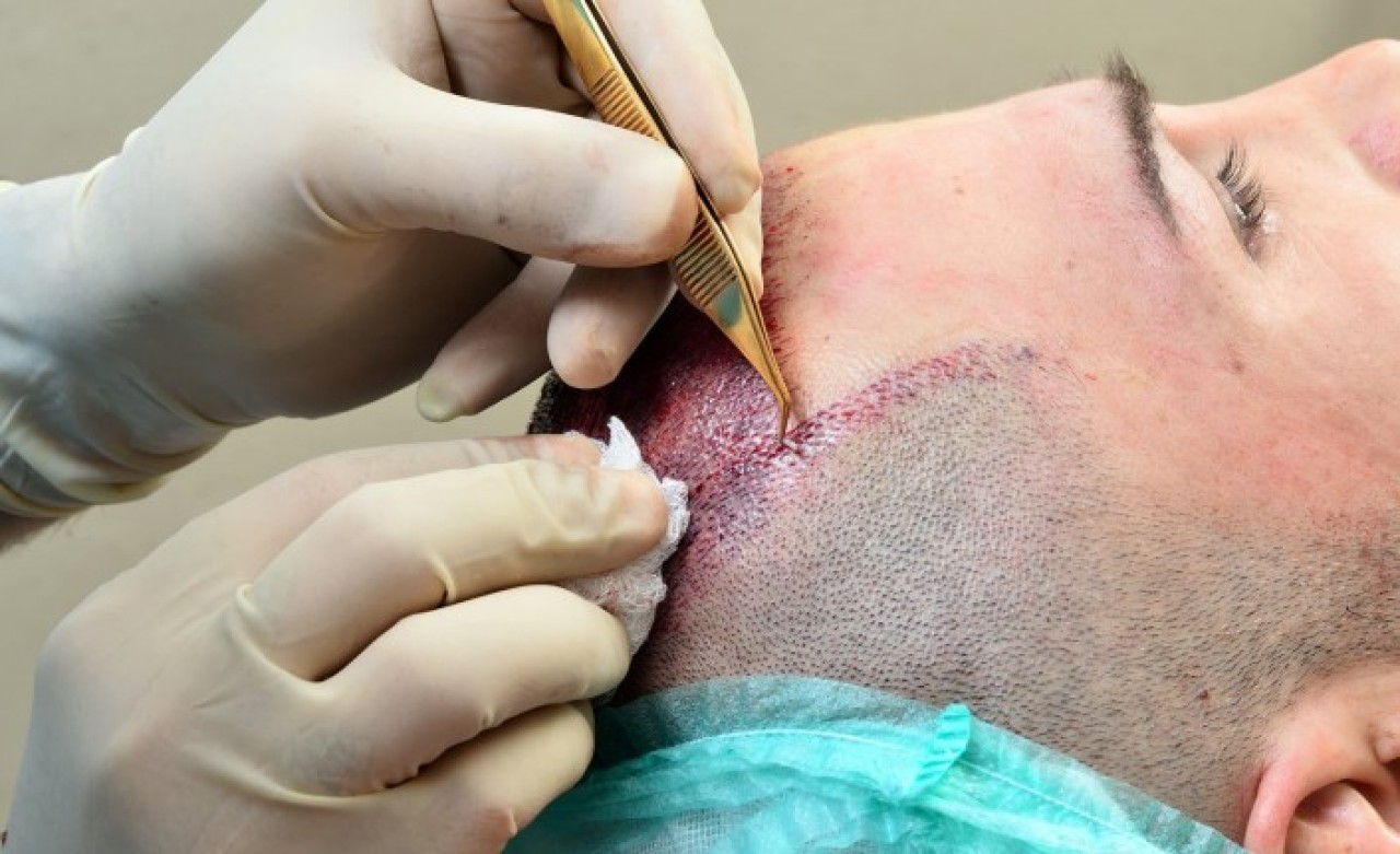 Saç Ekim'i Yapan Kliniklerin Özellikleri Nasıl Olmalıdır? Smile Hair Clinic