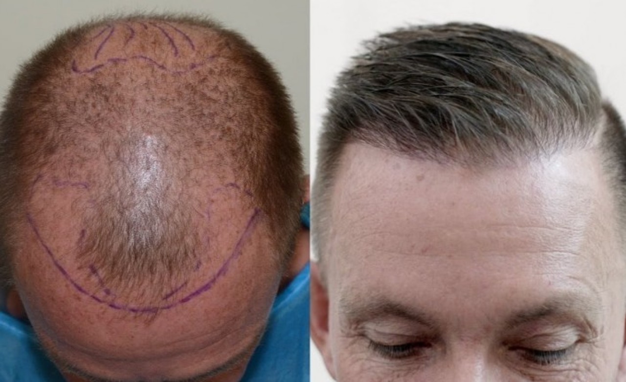 Saç Ekimi ve Sakal Ekimi Nasıl Yapılır?