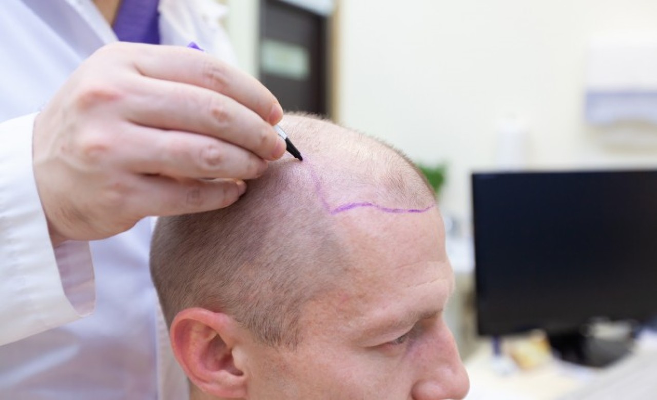 Saç Ekimi Öncesinde Dikkat Etmeniz Gerekenler