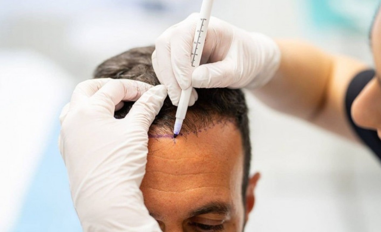 Teknik Saç Ekimi Rehberi