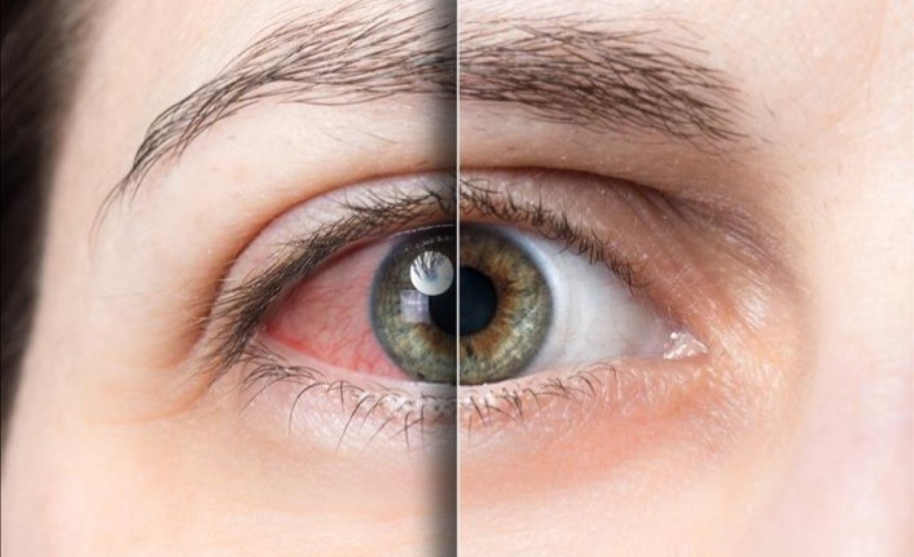 Uzun süre ekrana bakmak kuru göze davetiye çıkarıyor