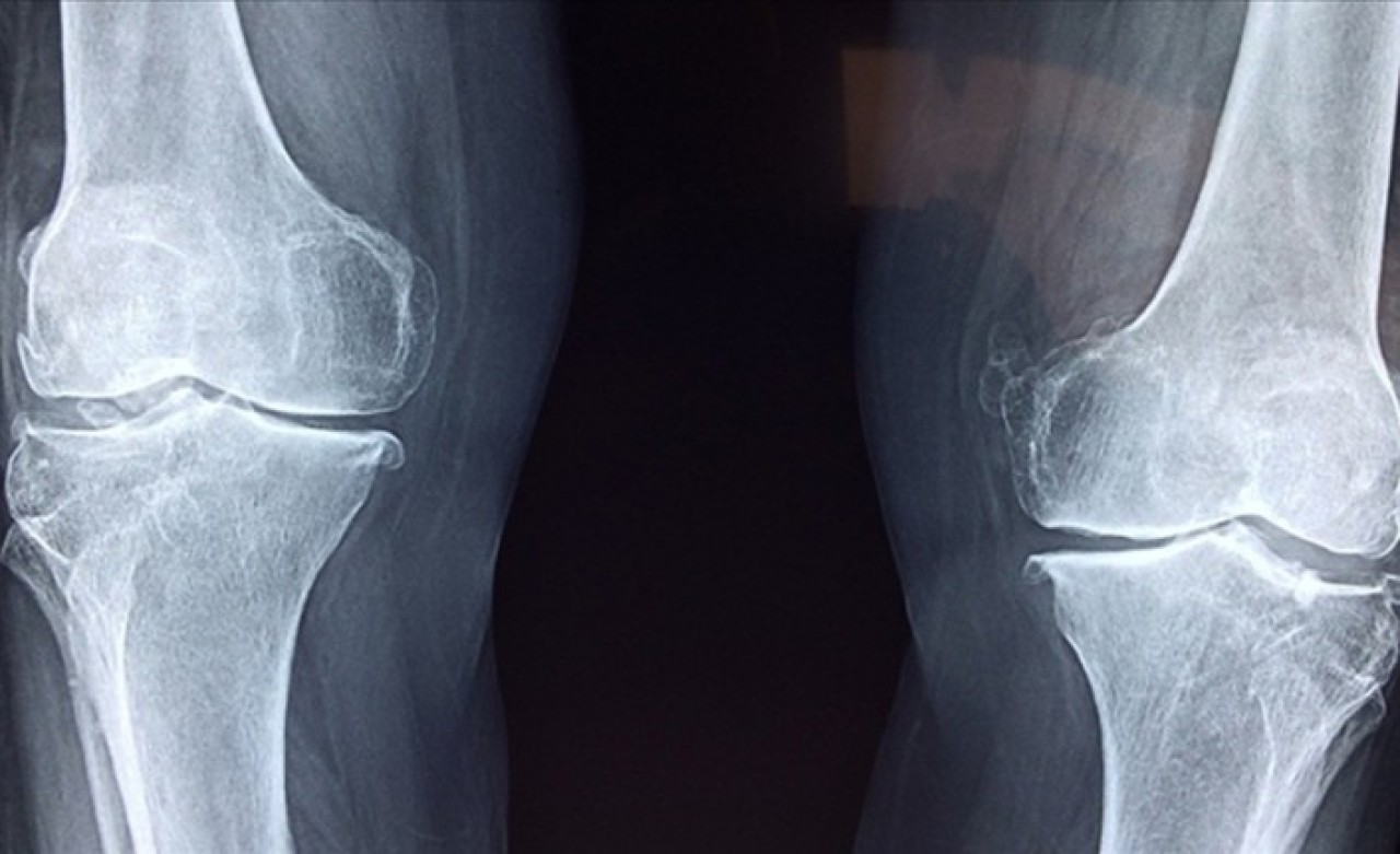 Eklem iltihabında erken tanı,  sakatlık ve iş gücü kaybını önlüyor