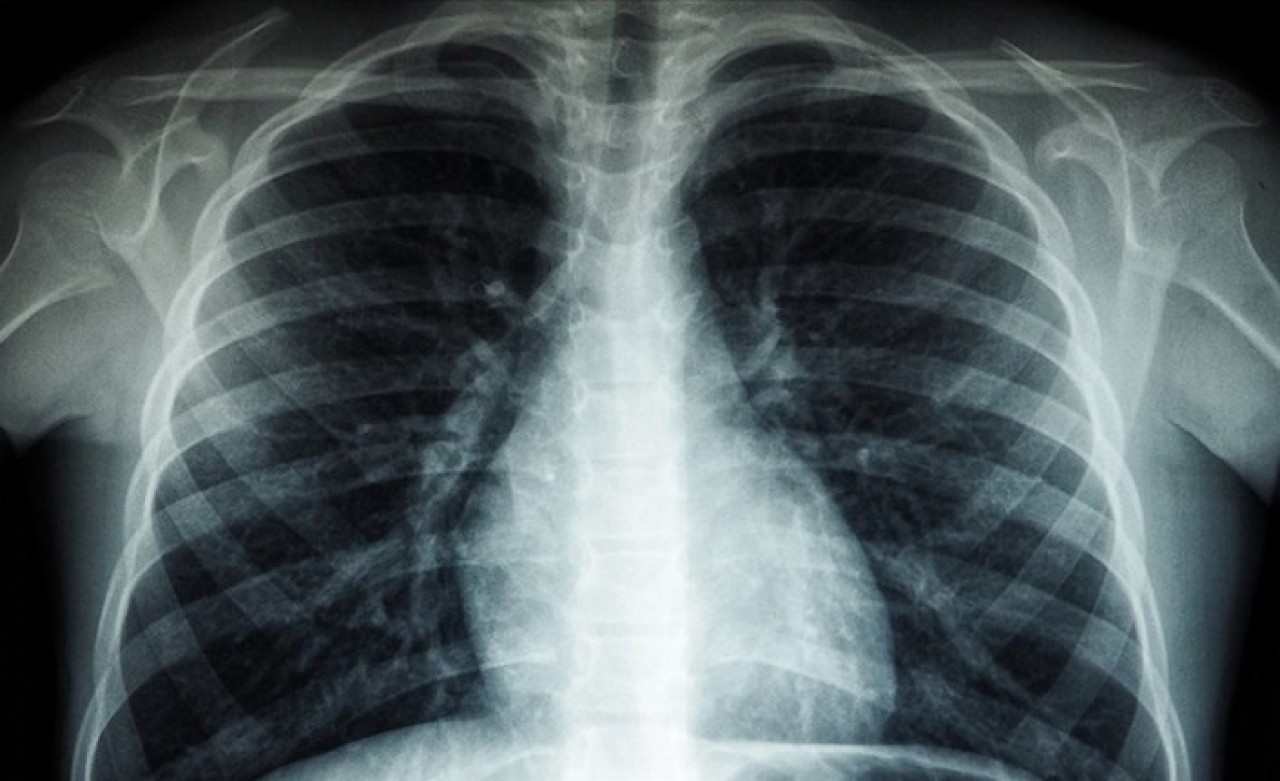 Kovid-19 akciğer katılaşmasına neden olabiliyor