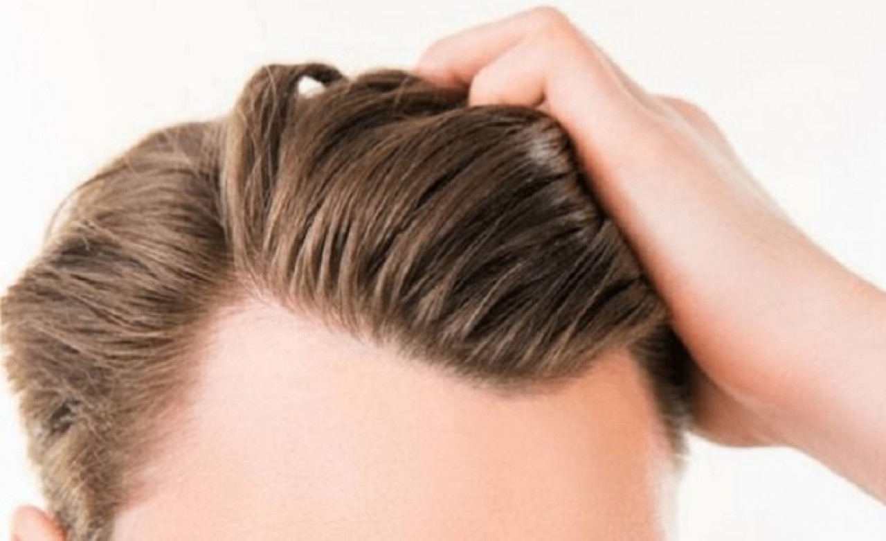 Saç Ekimi Nasıl Yapılır? Kimler Uygundur... Este Favor Anlatıyor!