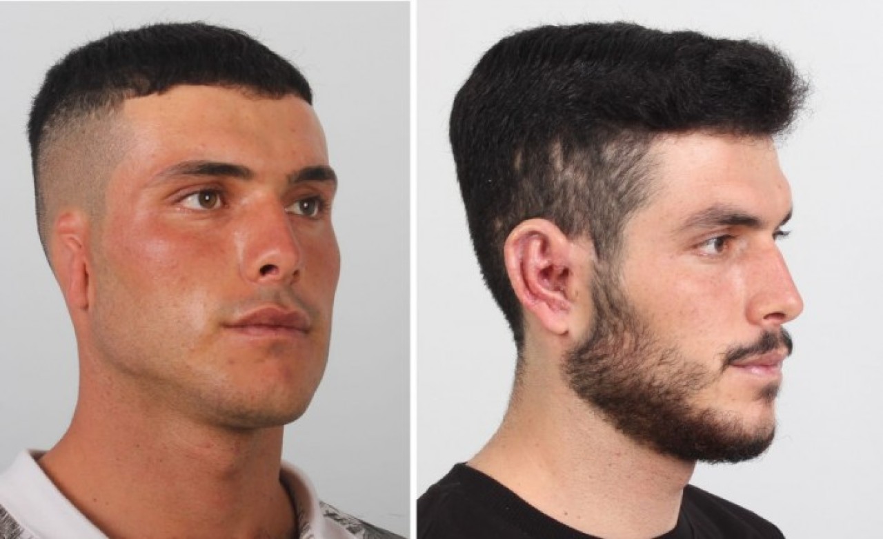 Göğüs kafesinden alınan kıkırdakla kulak kepçesi