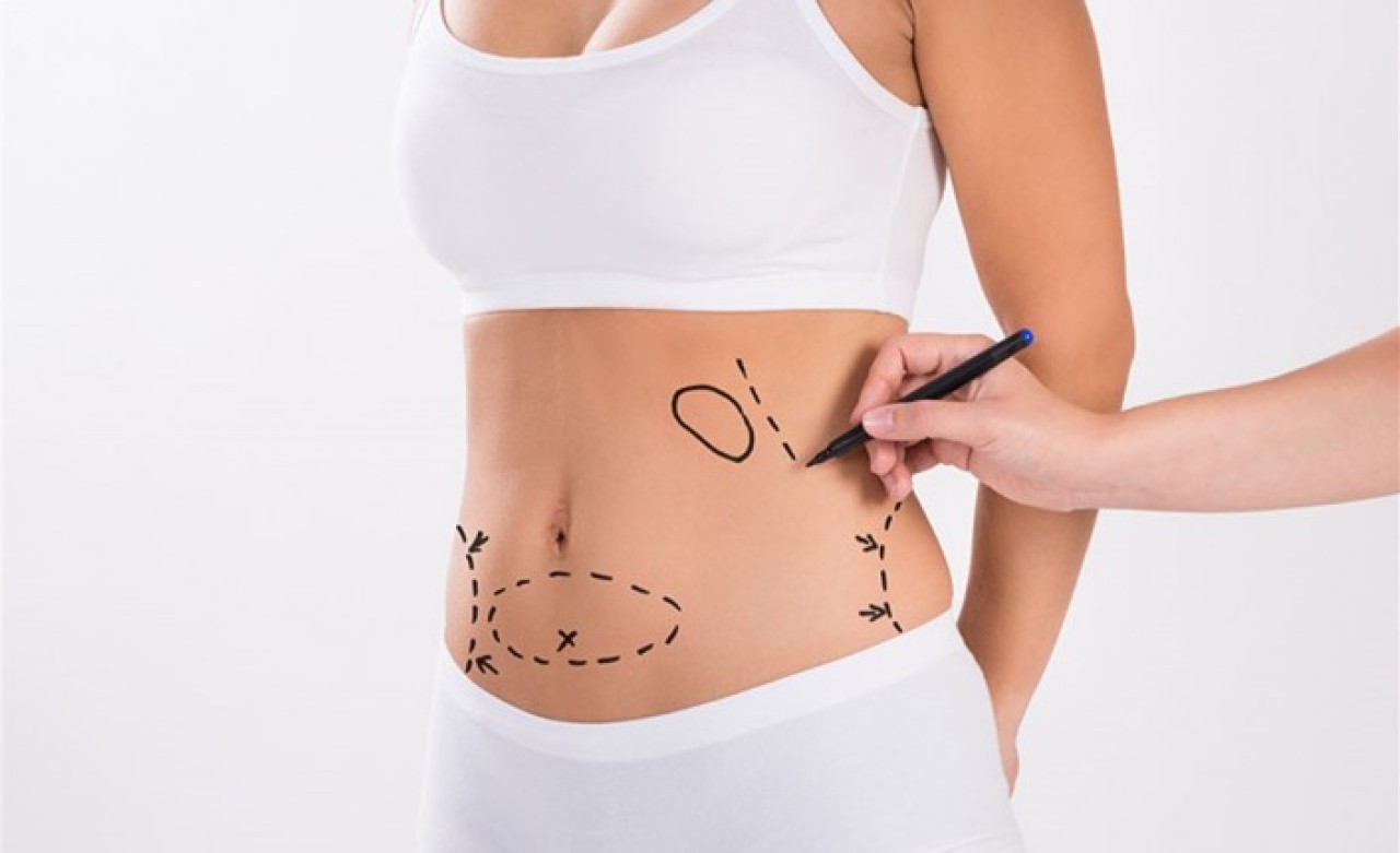 Liposuction Hakkında Bilinmesi Gerekenler