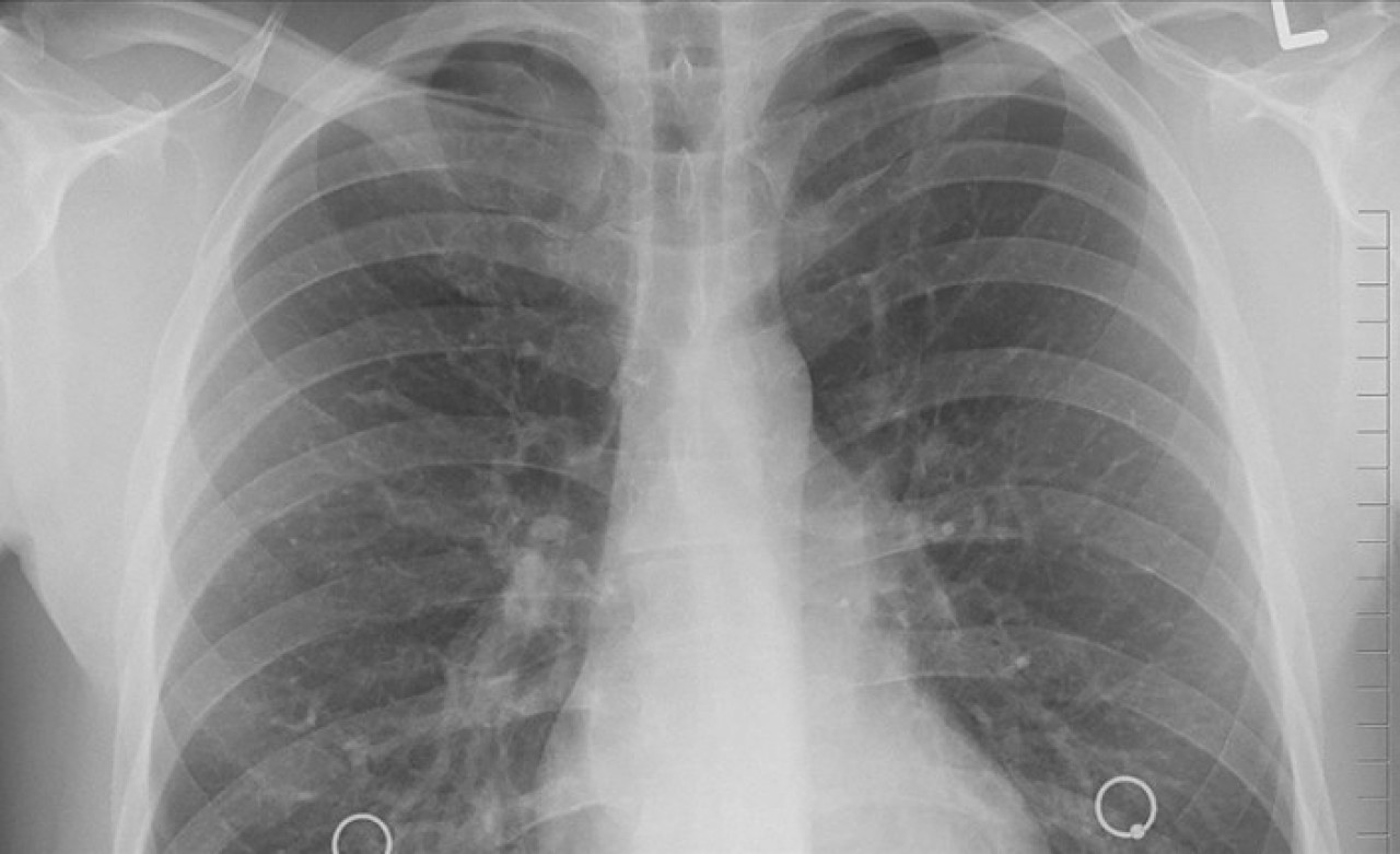 Türkiye'de yılda 35 bin kişi akciğer kanseri tanısı alıyor