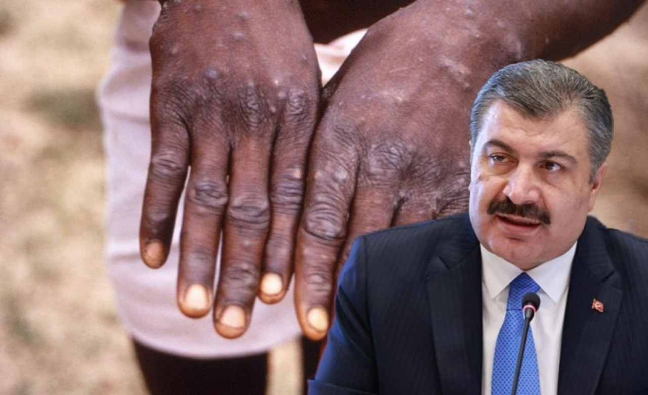 Bir pandemi daha mı geliyor? Bakan Koca,  maymun çiçeği virüsü hakkında net konuştu