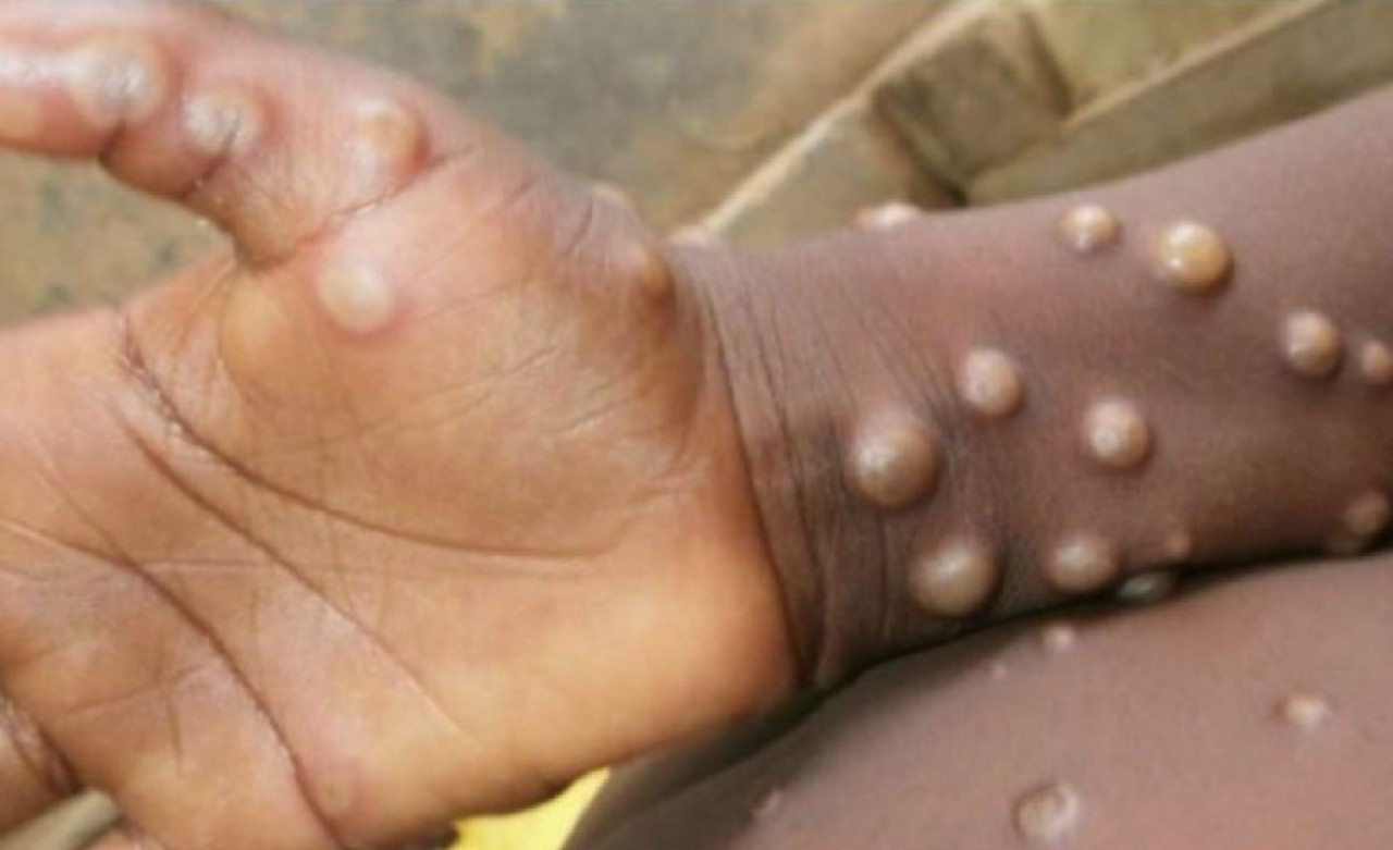 Koronadan sonra yeni virüs alarmı: Ölümcül virüs iki ülkeye daha sıçradı!