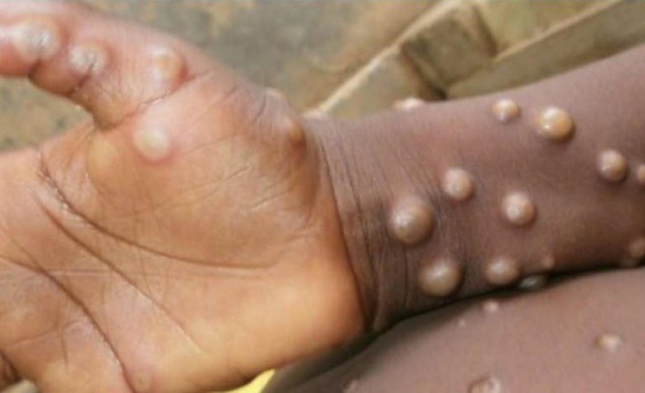 Sağlık Bakanlığı'ndan flaş maymun çiçeği virüsü açıklaması! Türkiye'de görüldü mü?